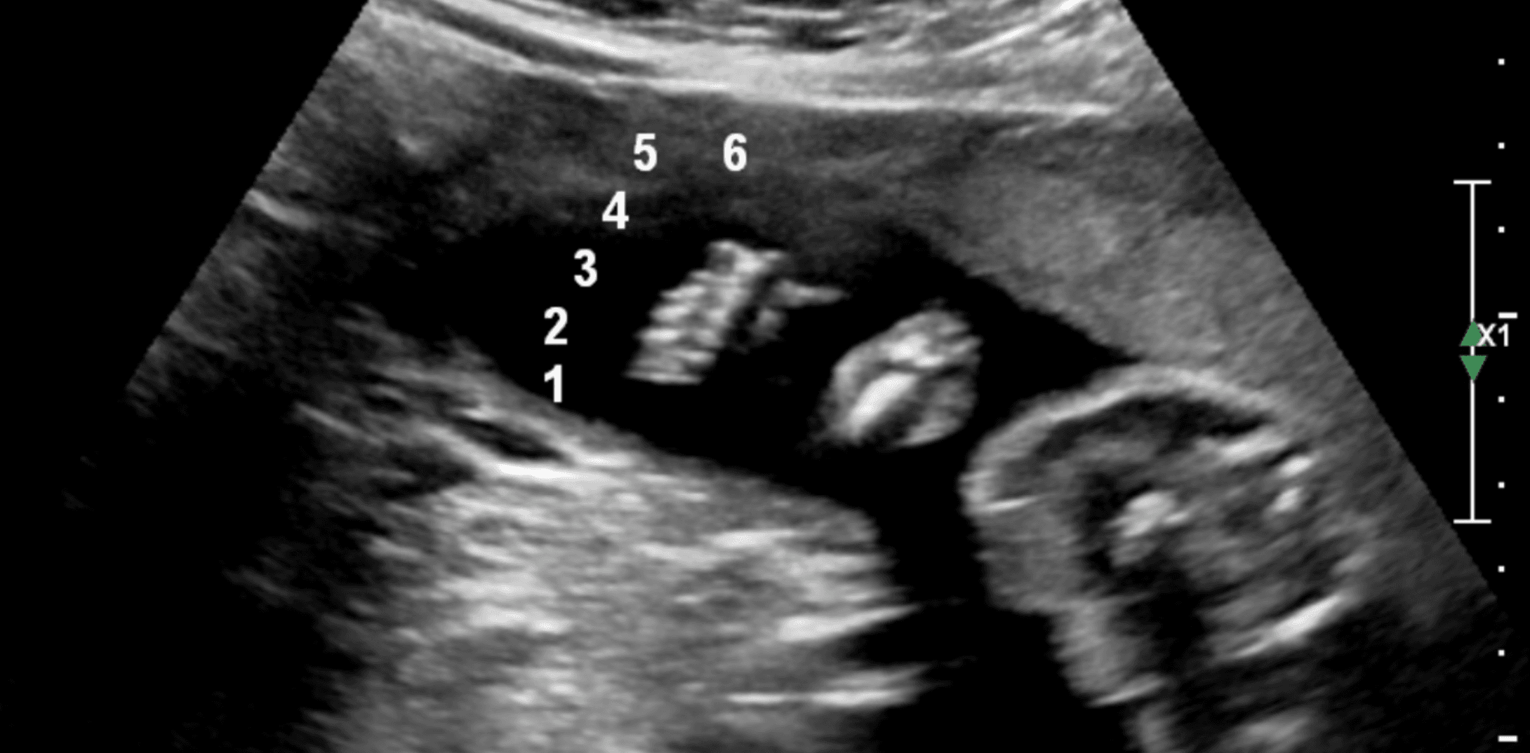 Scan of the Week: 6 Toes During a 20 Week Scan