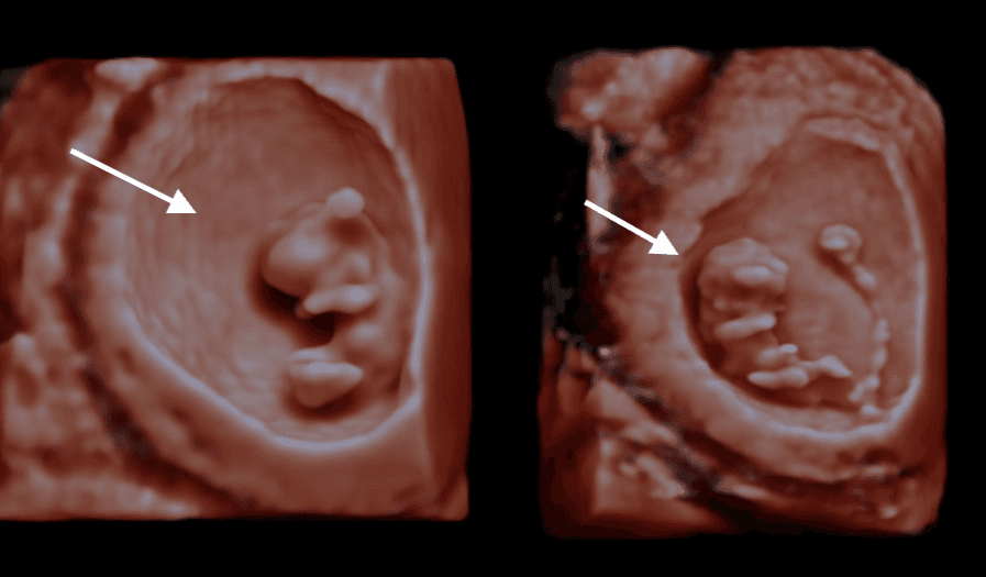 Scan of the Week: 9 Week Old Baby Scan